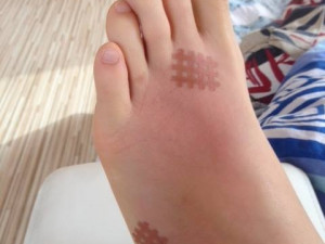 Noha, když opuchnutí ustupovalo