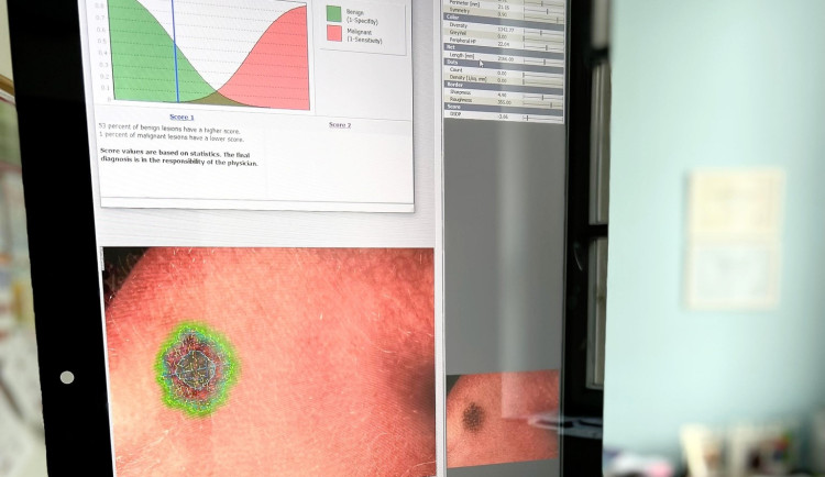 Vyšetření znamének novou metodou.