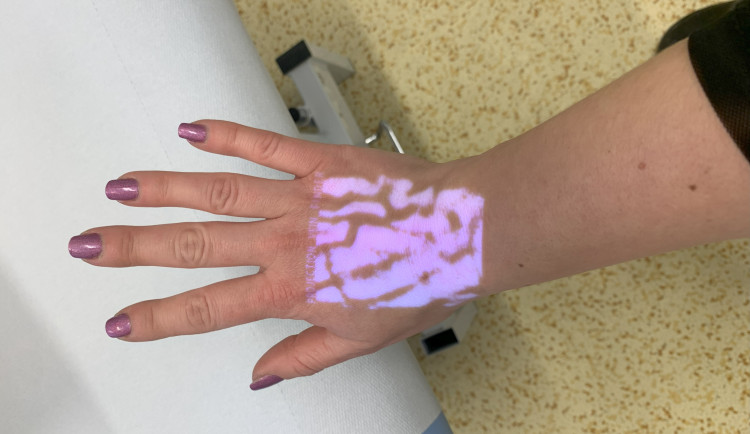 Zobrazení žil na ruce.