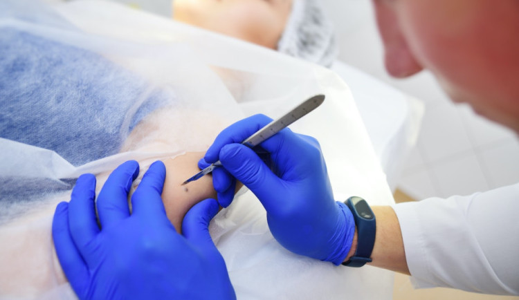 Nechte si po létu zkontrolovat znaménka, doporučují dermatologov