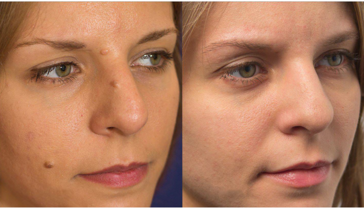 Plexr: Nová éra estetických zákroků bez skalpelu v Arendarska Care