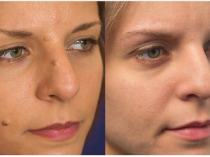 Plexr: Nová éra estetických zákroků bez skalpelu v Arendarska Care