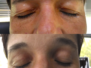 Plexr: Nová éra estetických zákroků bez skalpelu v Arendarska Care