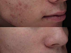 Plexr: Nová éra estetických zákroků bez skalpelu v Arendarska Care