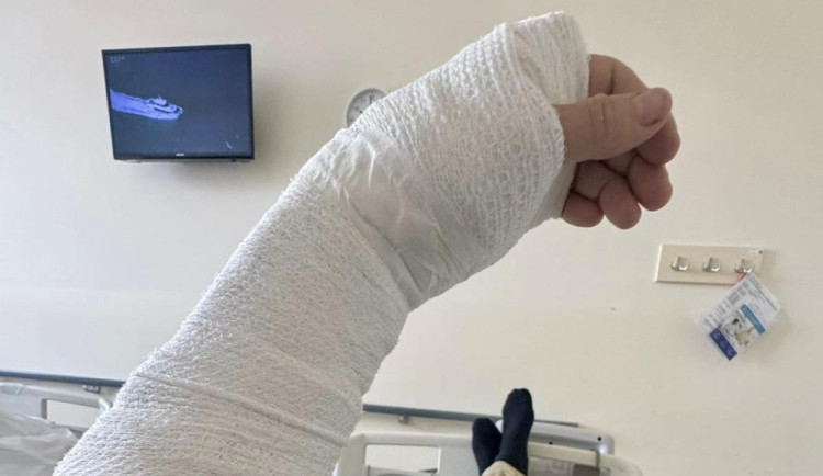 Hejtman Půta v nemocnici. Upadl na ulici a nadvakrát si zlomil ruku