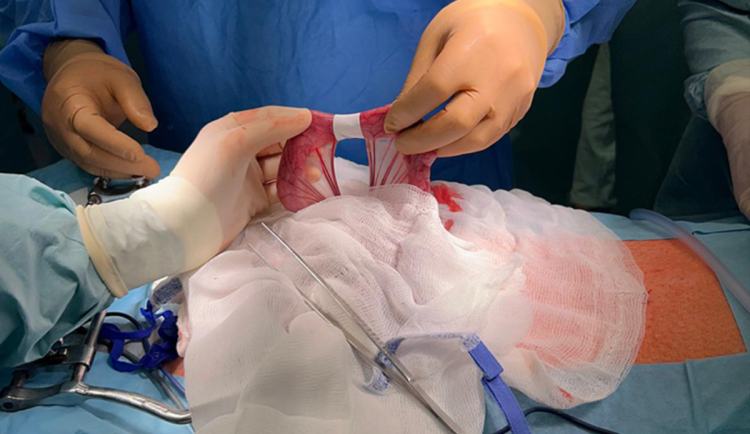 Miliony na vývoj nanonáplastí pro chirurgy. Vynález liberecké univerzity slibuje revoluci