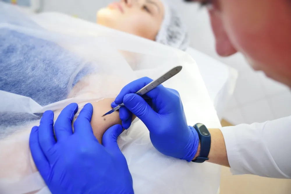 Nechte si po létu zkontrolovat znaménka, doporučují dermatologov
