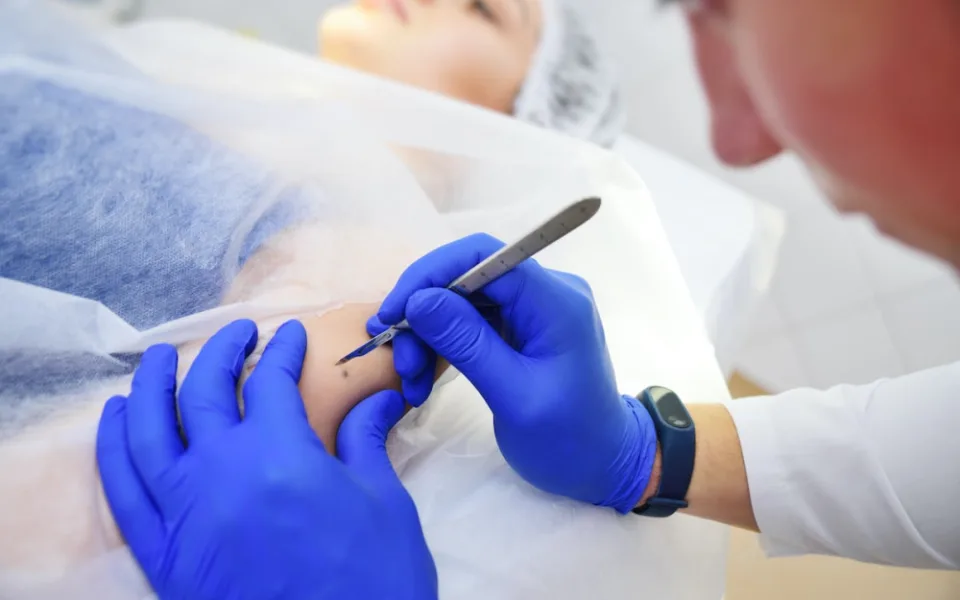 Nechte si po létu zkontrolovat znaménka, doporučují dermatologov